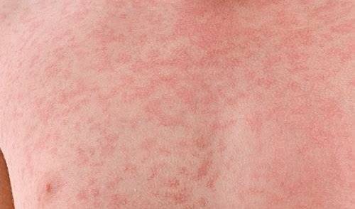 İstanbul’da Kızamık Alarmı !