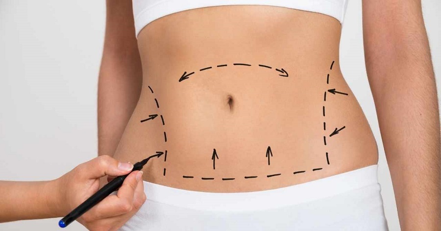 Karın Germe Ameliyatı